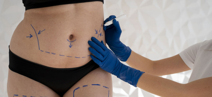 Tips For Recovery After An Abdominoplasty Procedure